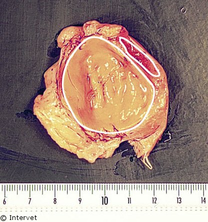 ovarian cyst